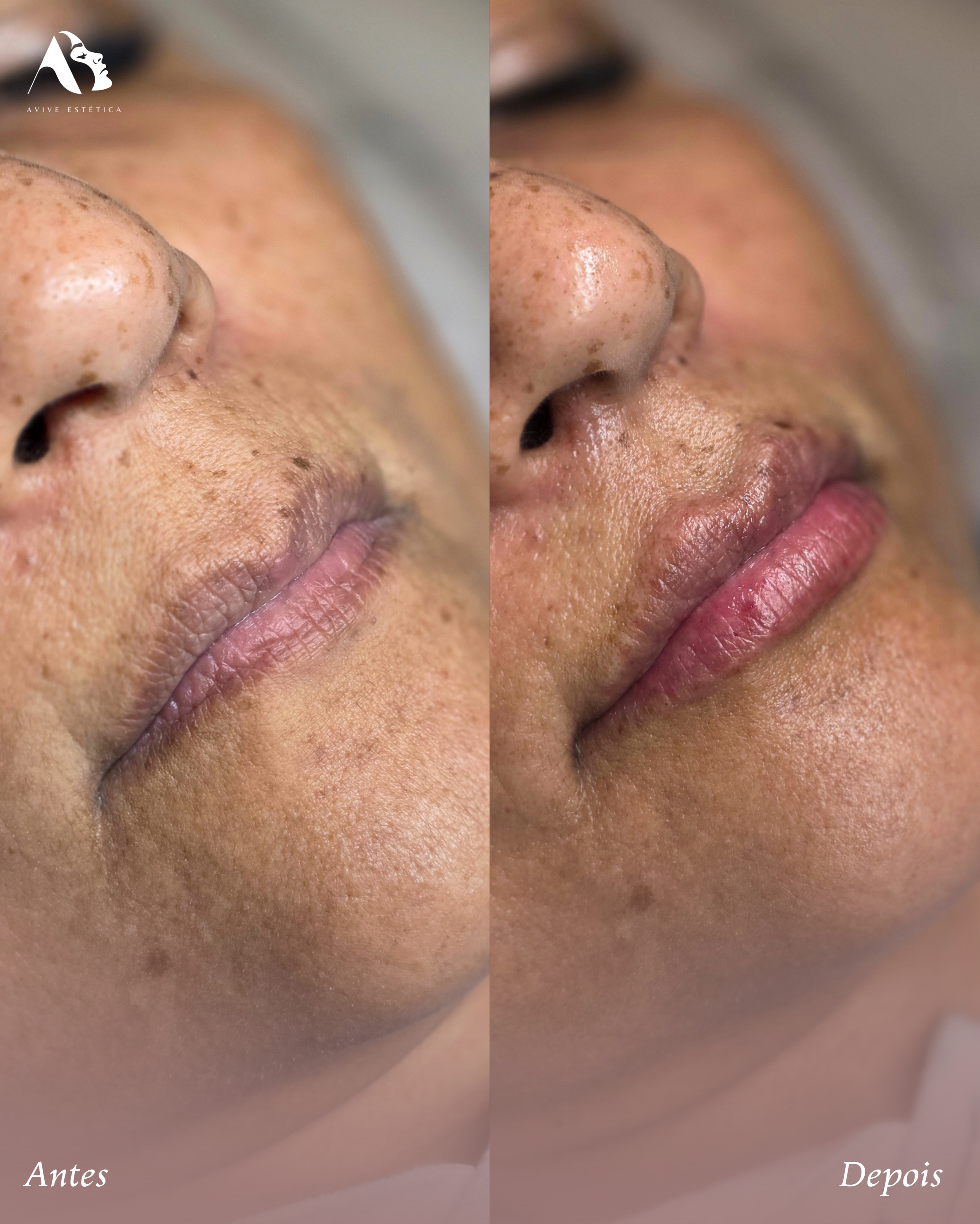 Cuidado labial · 03: depois